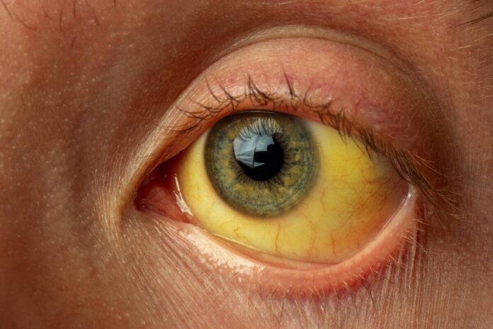Viens no C hepatīta simptomiem — acu baltumu dzelte. Foto: Daniil Dubov / Getty Images Viens no C hepatīta simptomiem — acu baltumu dzelte. Foto: Daniil Dubov / Getty Images